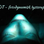 PDT med PRF